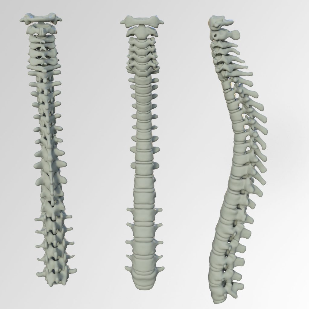 Sciatica-Disturbance-of-lumbar-spine-